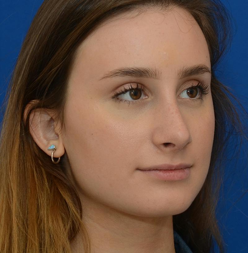 Rhinoplasty Before & After Gallery - Patient 293642 - Image 14