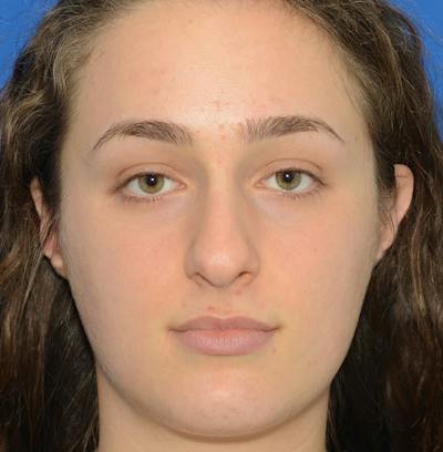 Rhinoplasty Before & After Gallery - Patient 963281 - Image 1
