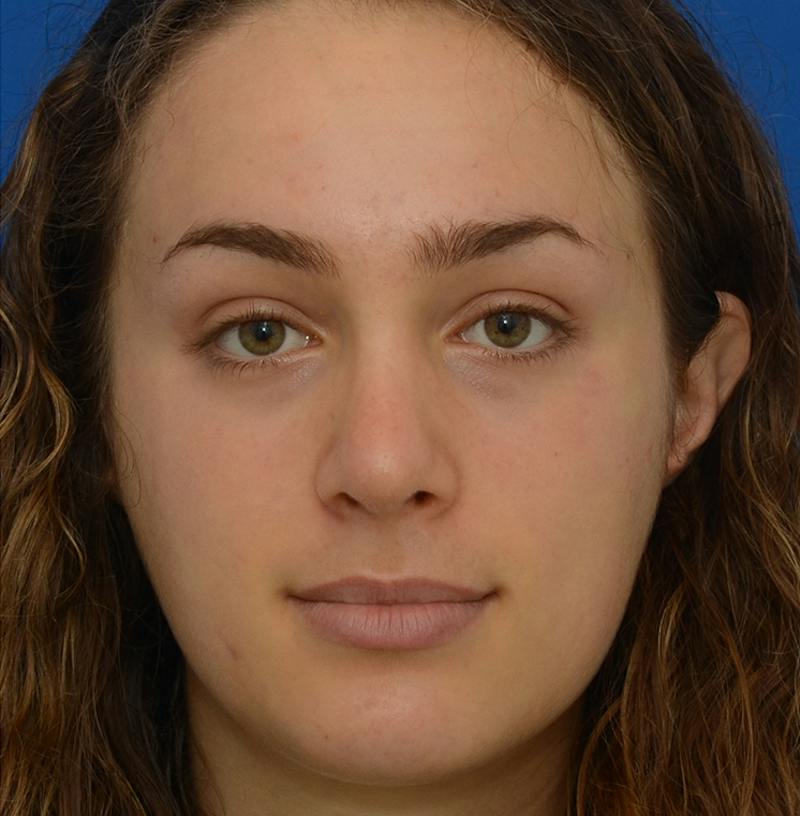 Rhinoplasty Before & After Gallery - Patient 963281 - Image 2