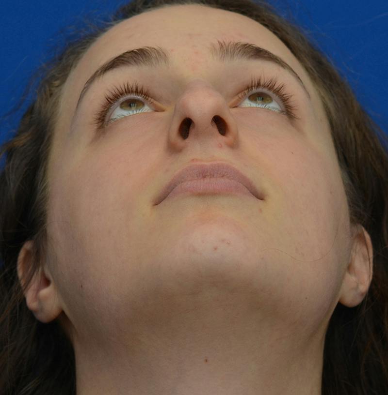 Rhinoplasty Before & After Gallery - Patient 963281 - Image 4
