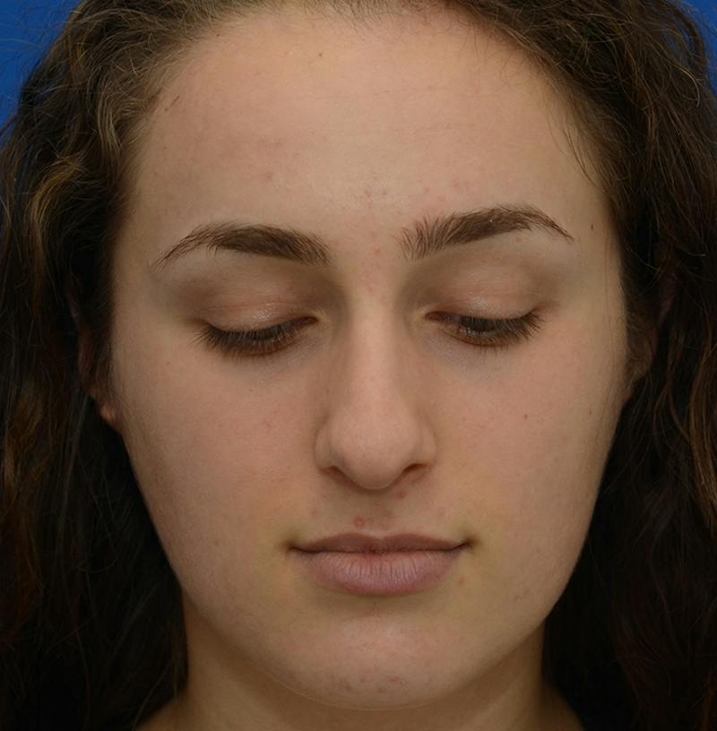 Rhinoplasty Before & After Gallery - Patient 963281 - Image 5