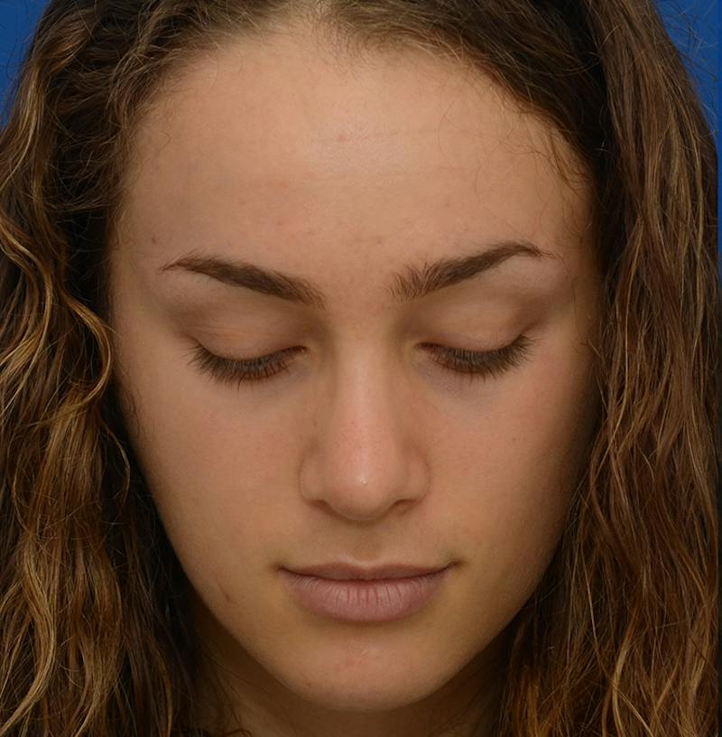 Rhinoplasty Before & After Gallery - Patient 963281 - Image 6