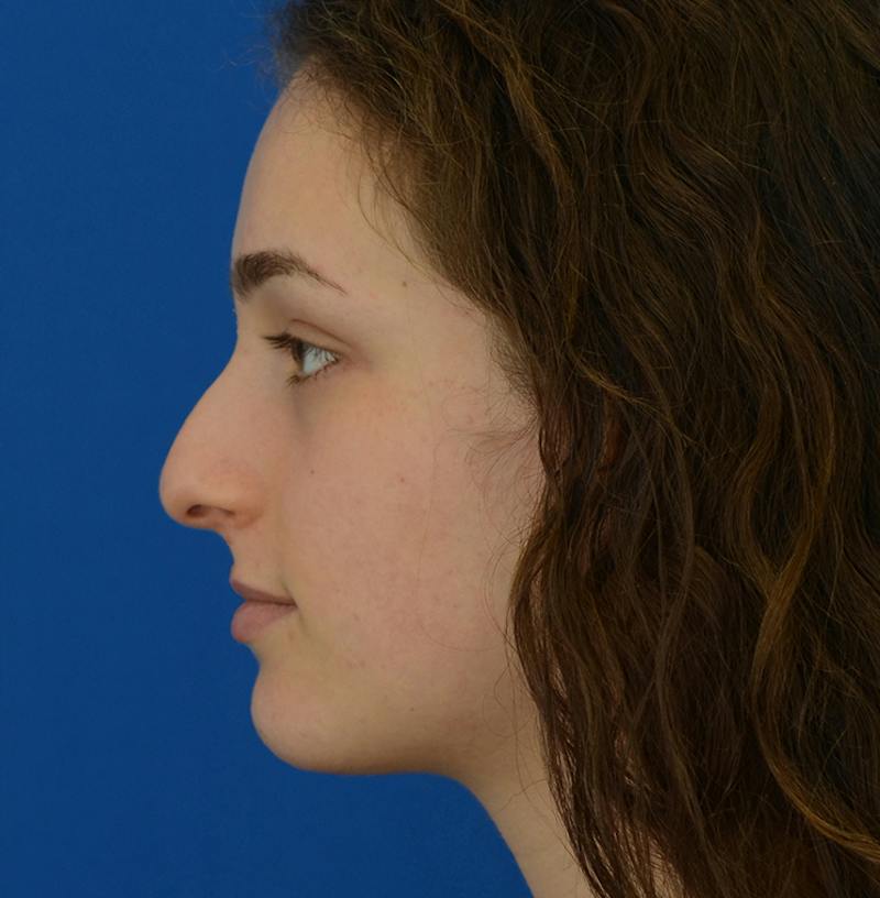 Rhinoplasty Before & After Gallery - Patient 963281 - Image 7