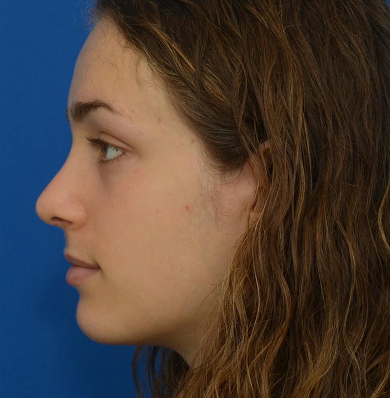 Rhinoplasty Before & After Gallery - Patient 963281 - Image 8