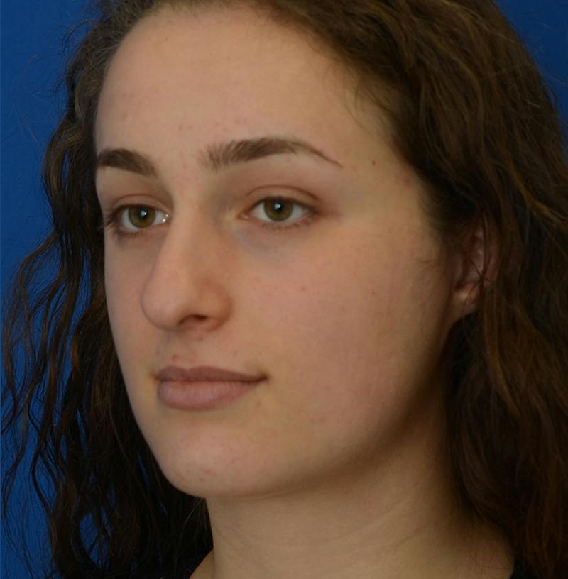 Rhinoplasty Before & After Gallery - Patient 963281 - Image 9