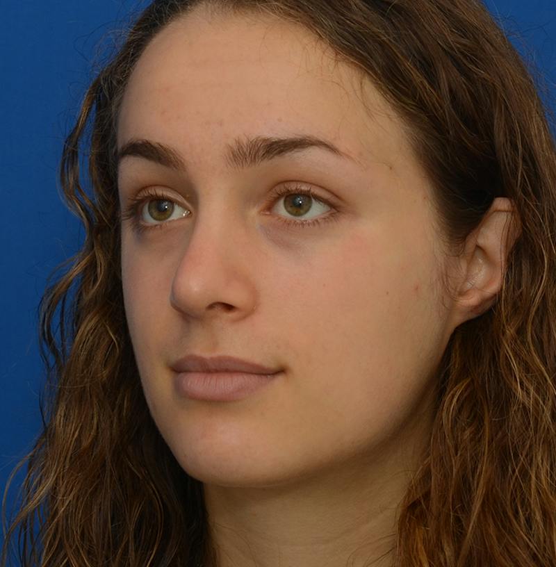 Rhinoplasty Before & After Gallery - Patient 963281 - Image 10