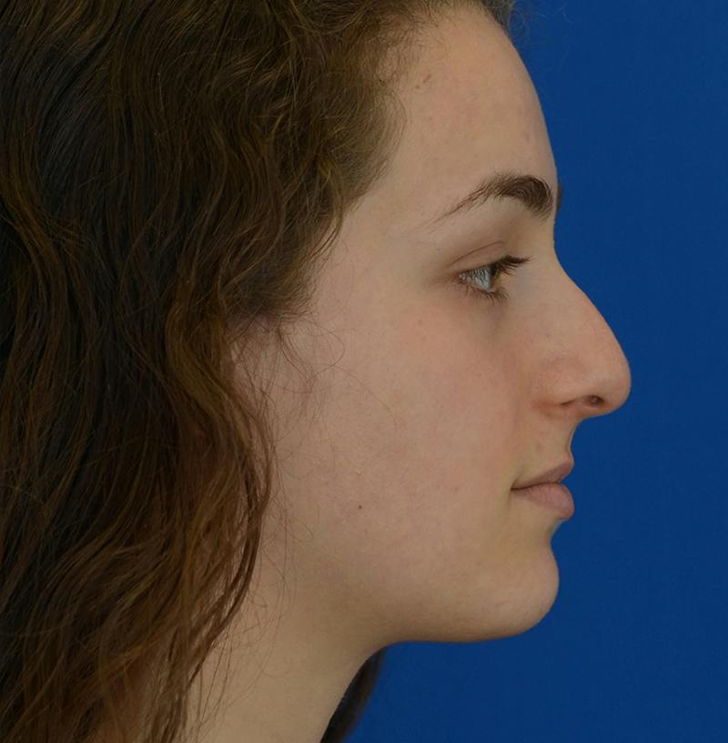 Rhinoplasty Before & After Gallery - Patient 963281 - Image 11