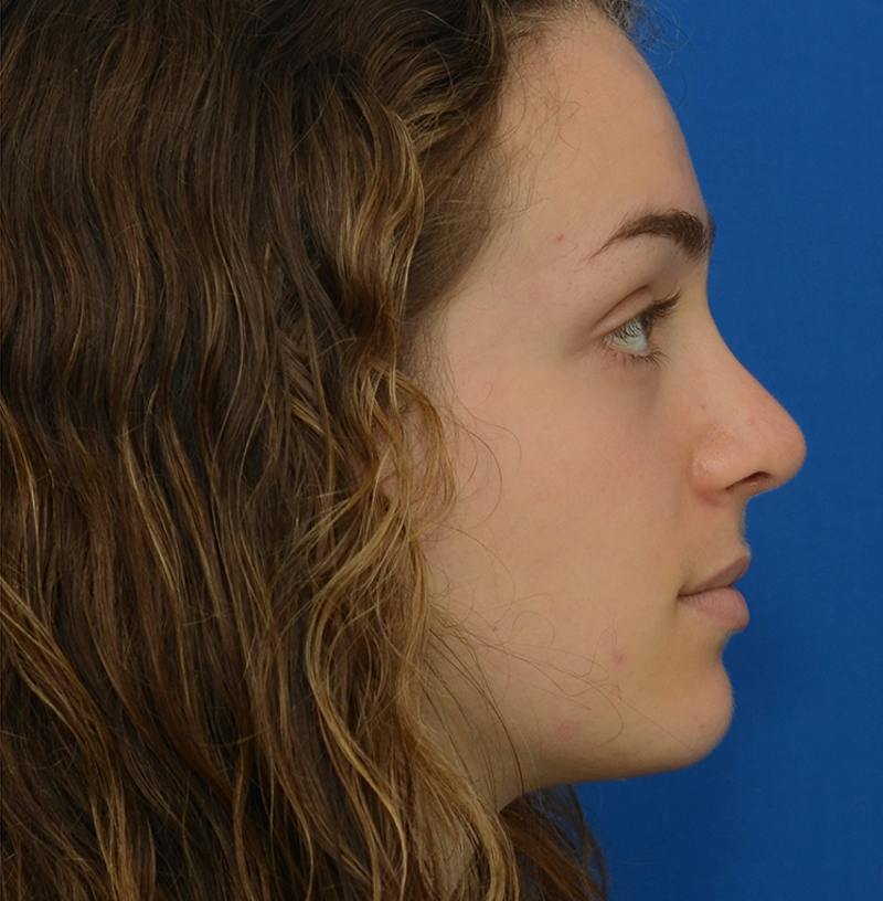 Rhinoplasty Before & After Gallery - Patient 963281 - Image 12