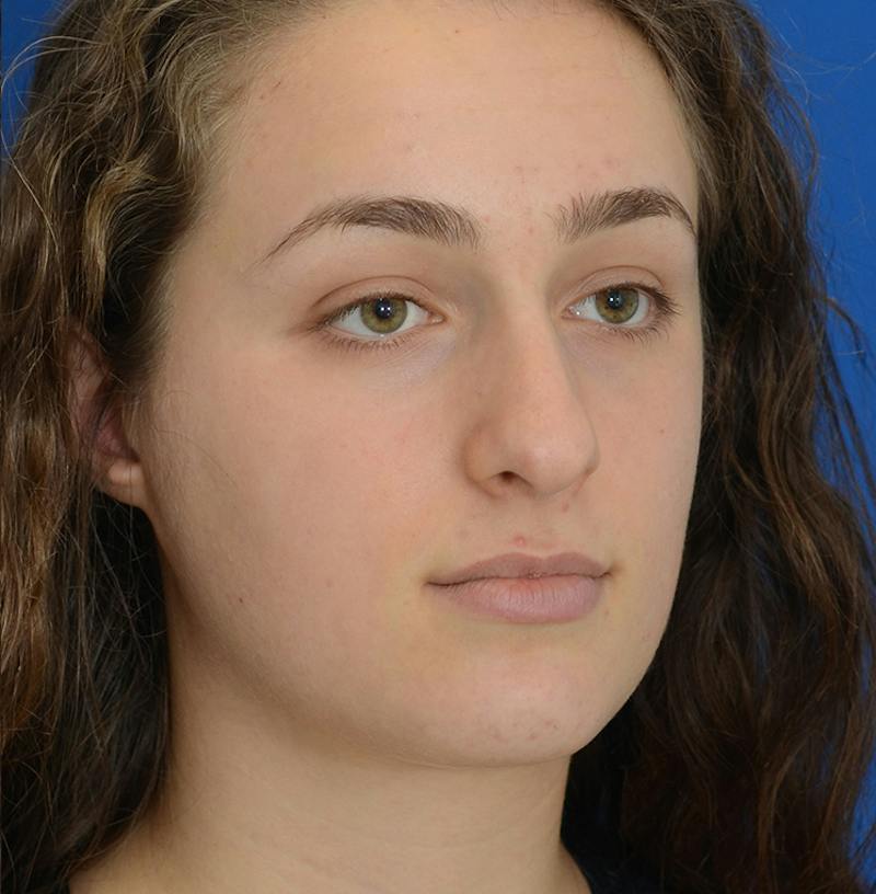 Rhinoplasty Before & After Gallery - Patient 963281 - Image 13