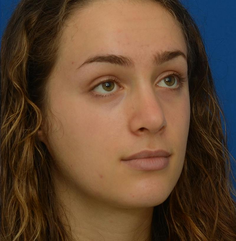 Rhinoplasty Before & After Gallery - Patient 963281 - Image 14