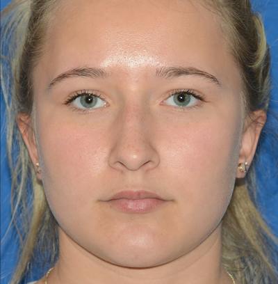 Rhinoplasty Before & After Gallery - Patient 298821 - Image 1