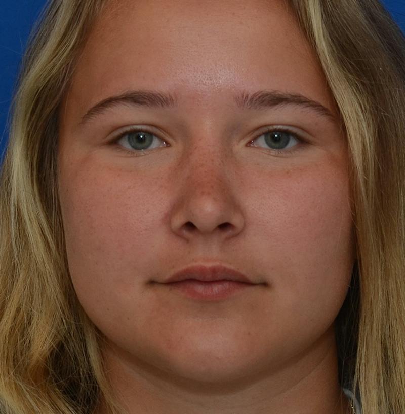 Rhinoplasty Before & After Gallery - Patient 298821 - Image 2