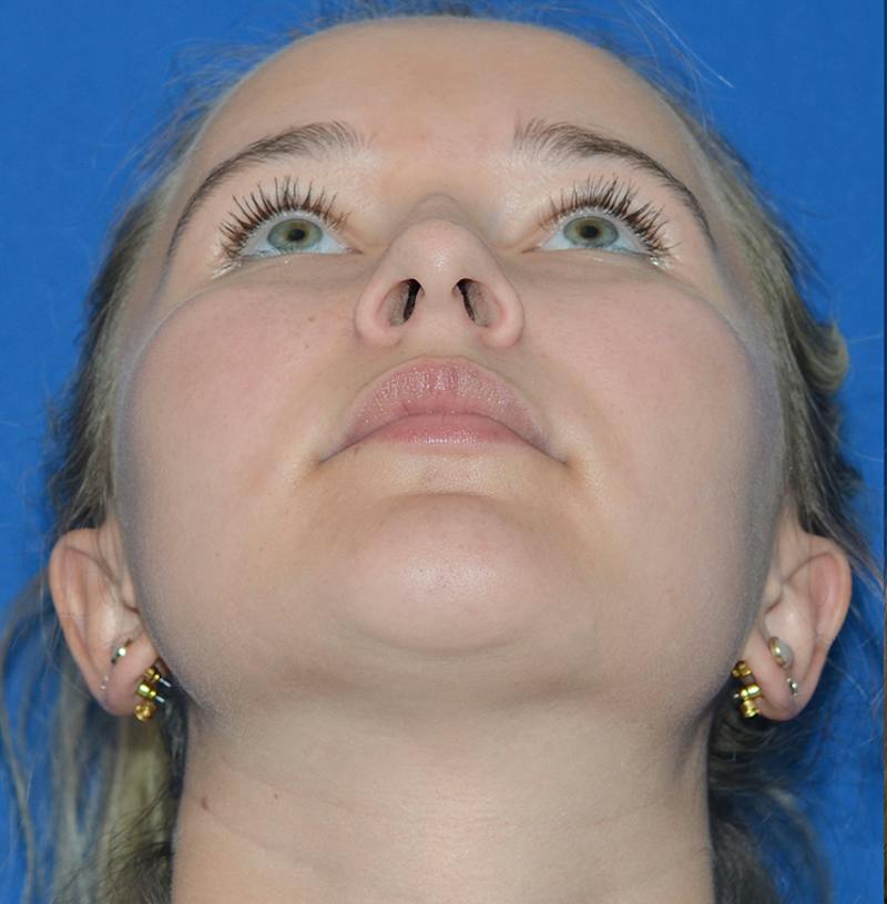 Rhinoplasty Before & After Gallery - Patient 298821 - Image 3