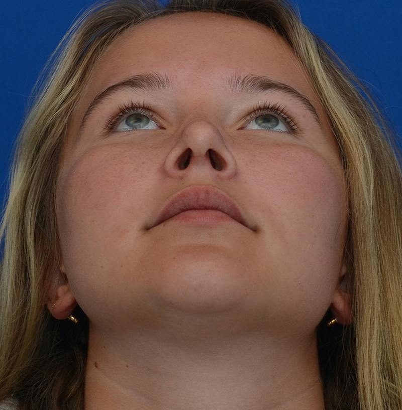 Rhinoplasty Before & After Gallery - Patient 298821 - Image 4