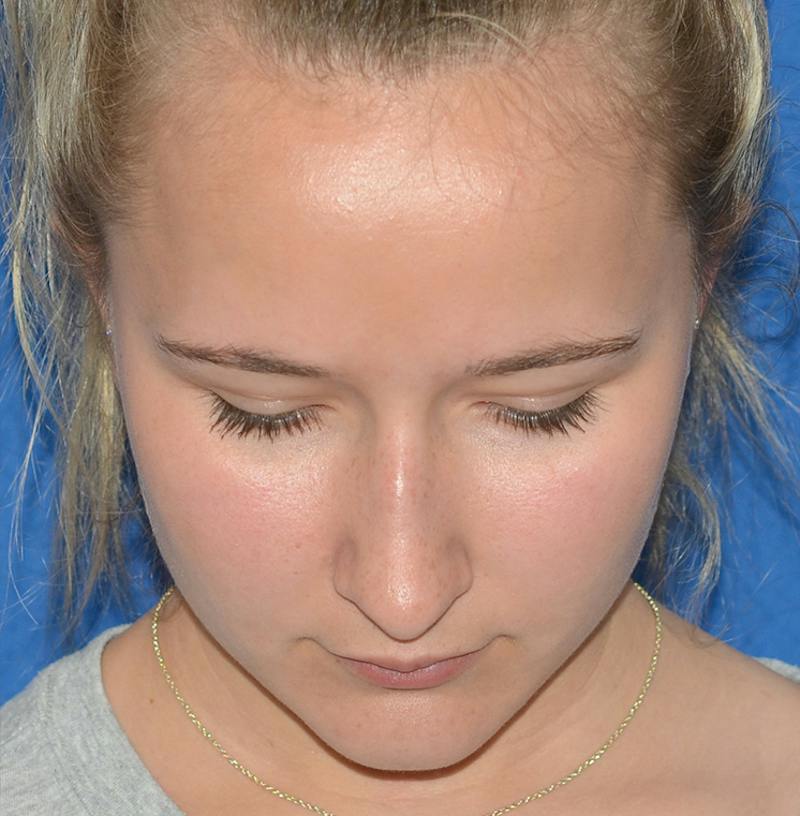 Rhinoplasty Before & After Gallery - Patient 298821 - Image 5