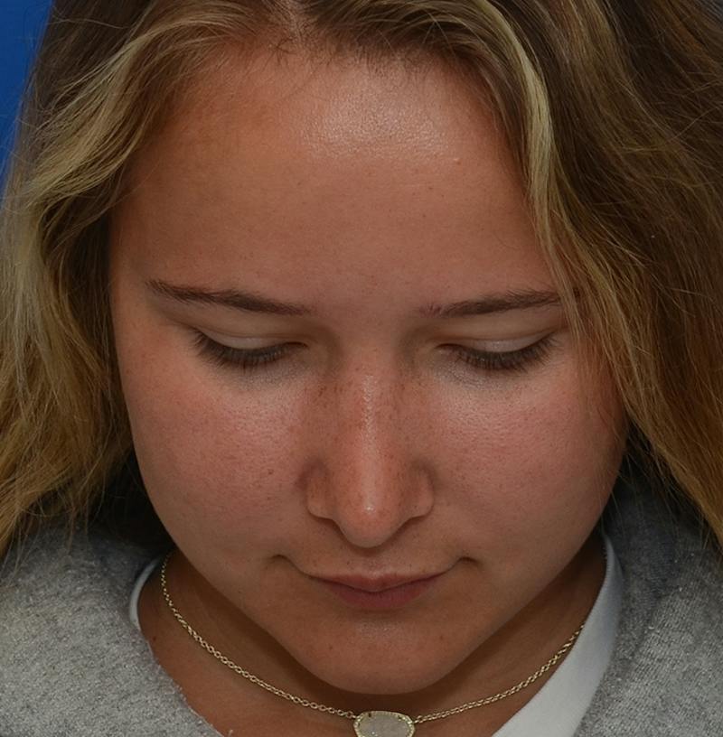 Rhinoplasty Before & After Gallery - Patient 298821 - Image 6
