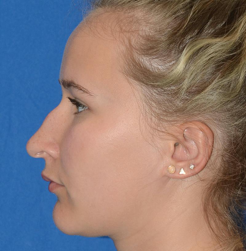 Rhinoplasty Before & After Gallery - Patient 298821 - Image 7
