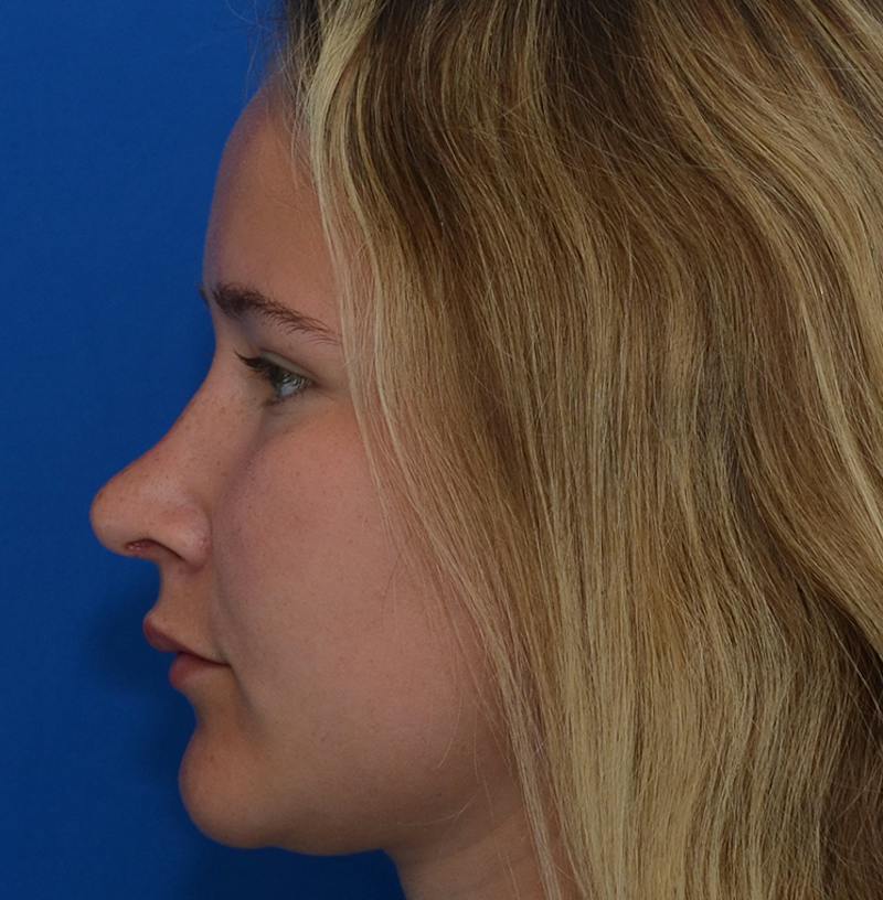 Rhinoplasty Before & After Gallery - Patient 298821 - Image 8