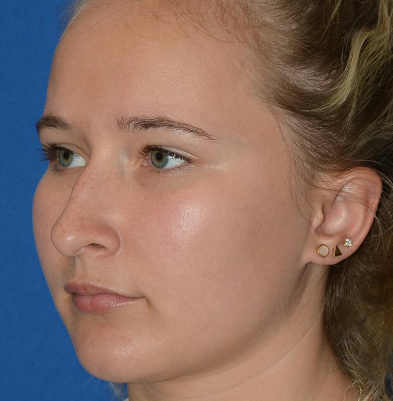 Rhinoplasty Before & After Gallery - Patient 298821 - Image 9