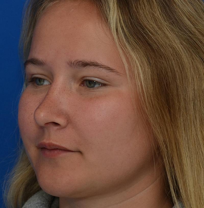 Rhinoplasty Before & After Gallery - Patient 298821 - Image 10