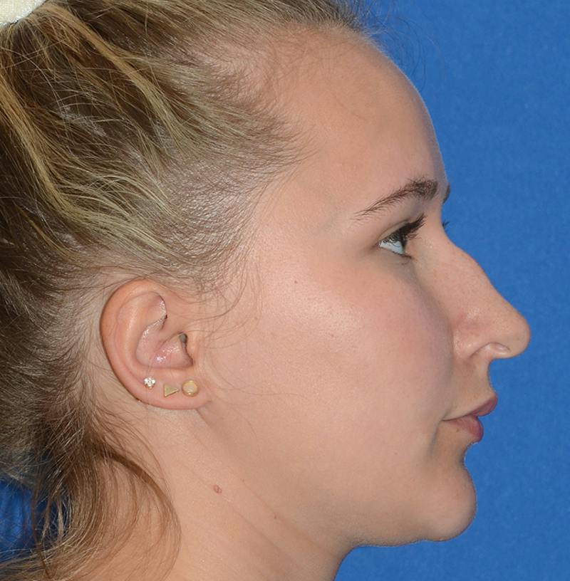 Rhinoplasty Before & After Gallery - Patient 298821 - Image 11