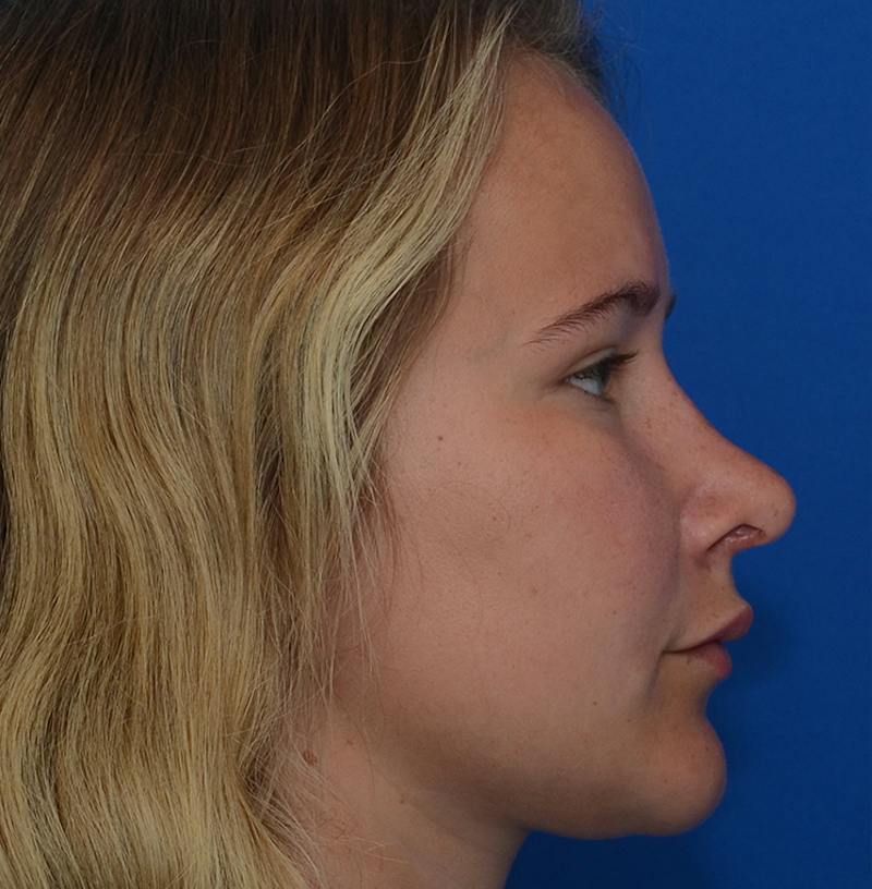 Rhinoplasty Before & After Gallery - Patient 298821 - Image 12