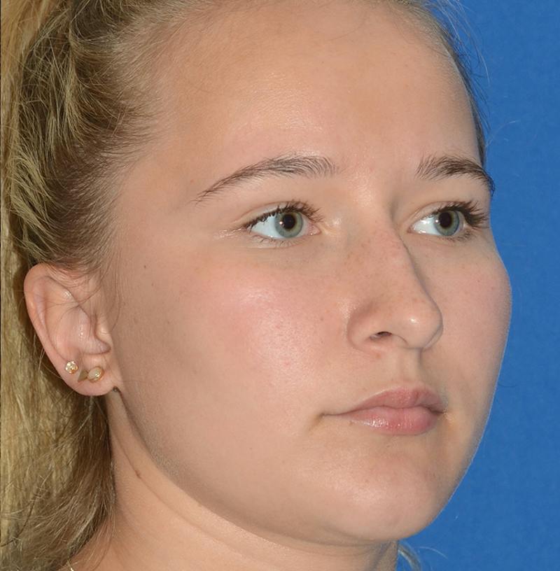 Rhinoplasty Before & After Gallery - Patient 298821 - Image 13