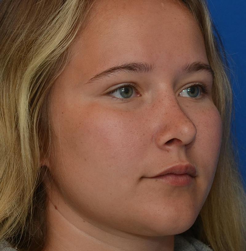 Rhinoplasty Before & After Gallery - Patient 298821 - Image 14