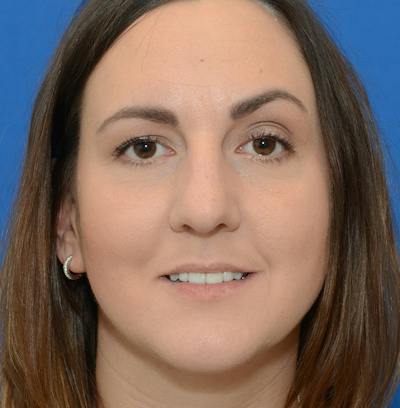 Rhinoplasty Before & After Gallery - Patient 514026 - Image 1