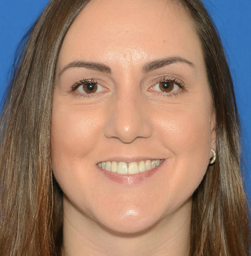 Rhinoplasty Before & After Gallery - Patient 514026 - Image 2