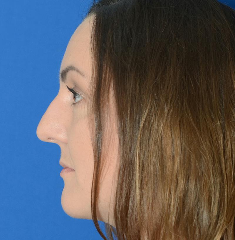 Rhinoplasty Before & After Gallery - Patient 514026 - Image 3