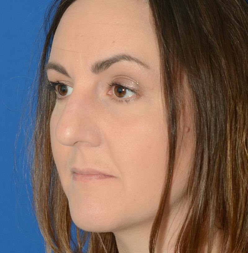 Rhinoplasty Before & After Gallery - Patient 514026 - Image 5