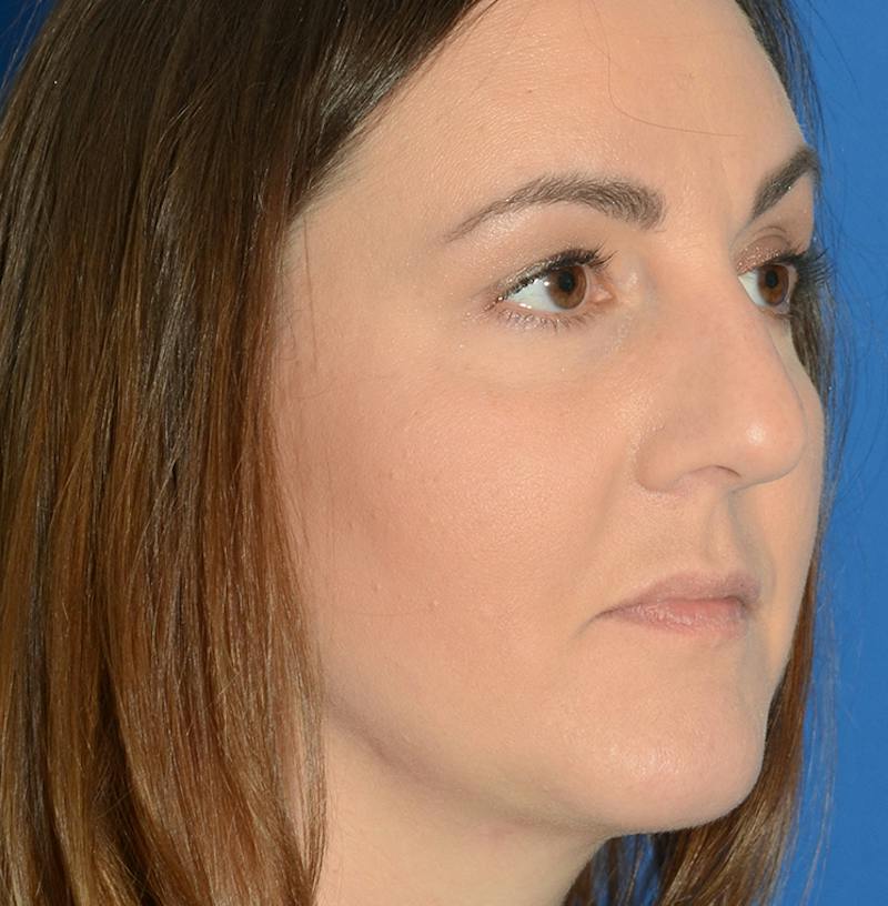 Rhinoplasty Before & After Gallery - Patient 514026 - Image 9