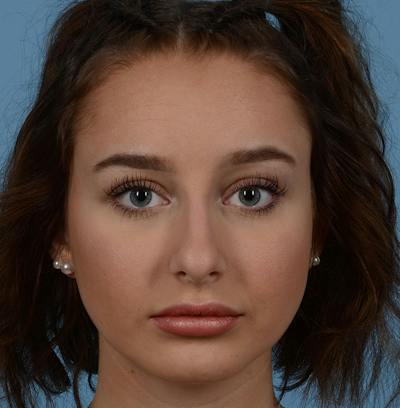 Rhinoplasty Before & After Gallery - Patient 170719 - Image 1
