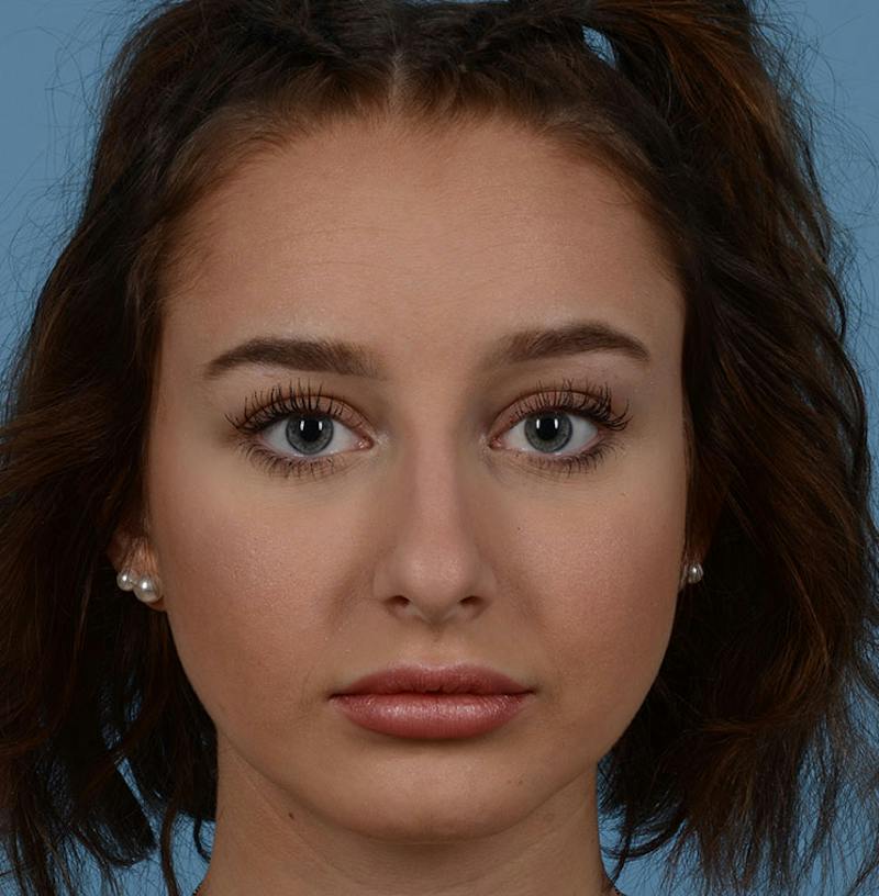 Rhinoplasty Before & After Gallery - Patient 170719 - Image 1