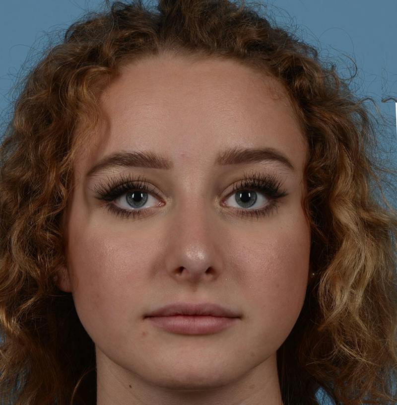 Rhinoplasty Before & After Gallery - Patient 170719 - Image 2