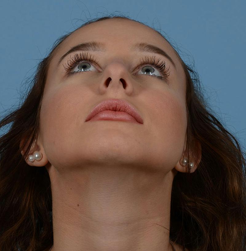 Rhinoplasty Before & After Gallery - Patient 170719 - Image 3