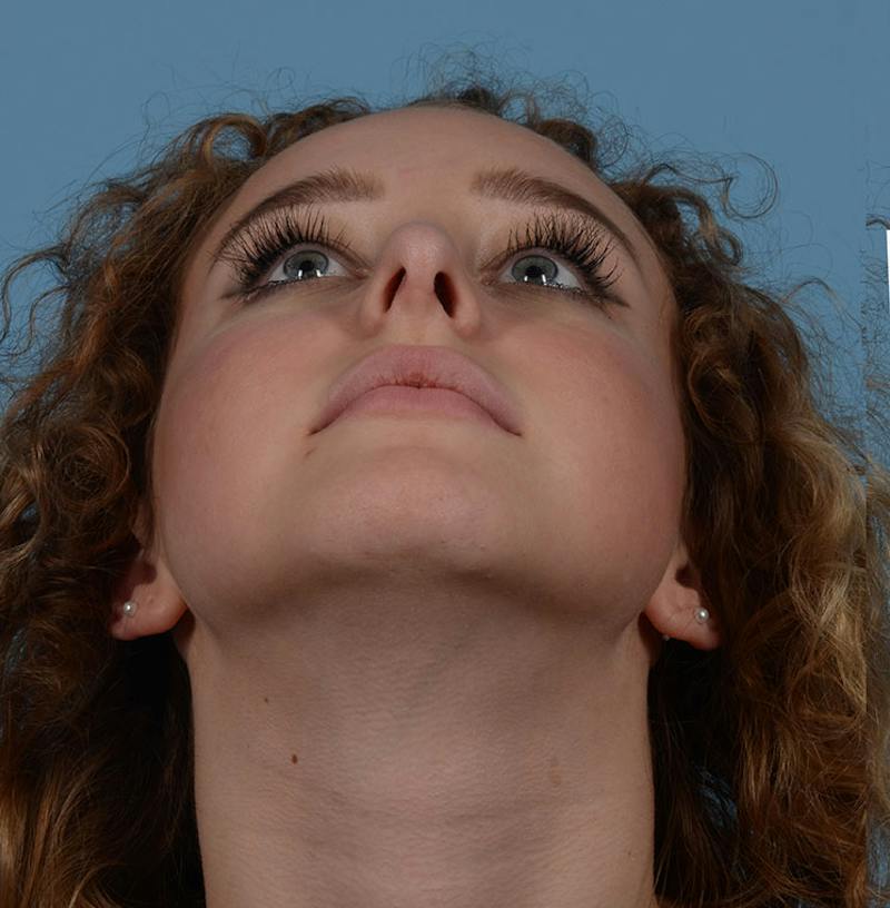 Rhinoplasty Before & After Gallery - Patient 170719 - Image 4
