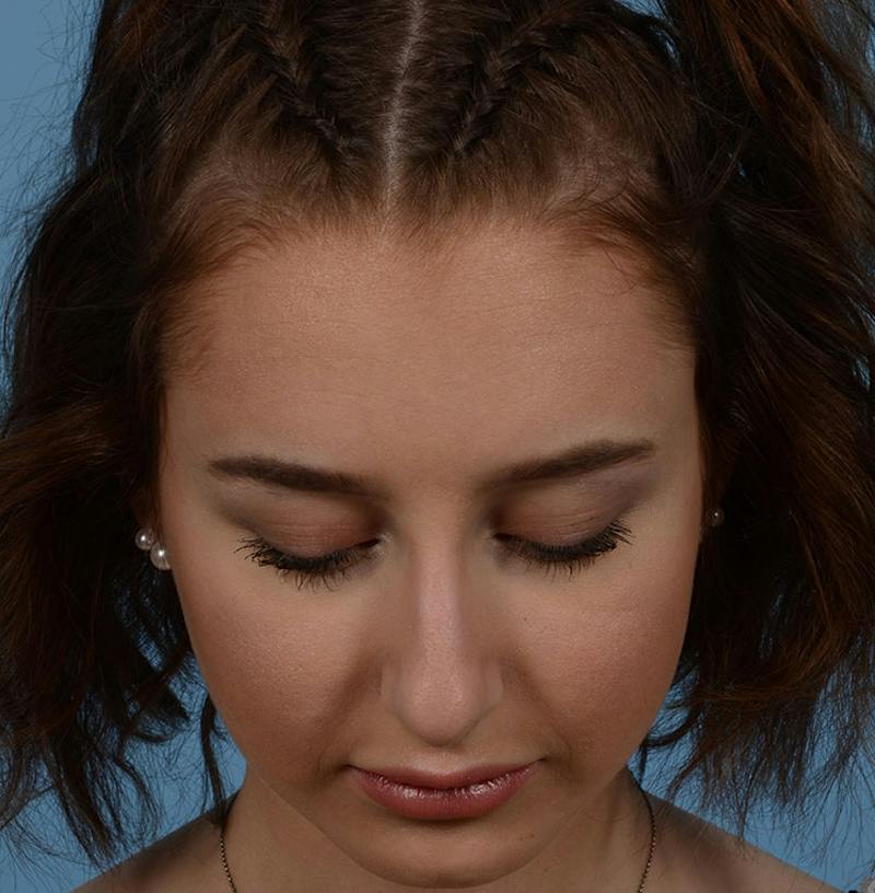 Rhinoplasty Before & After Gallery - Patient 170719 - Image 5