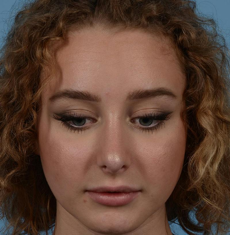 Rhinoplasty Before & After Gallery - Patient 170719 - Image 6