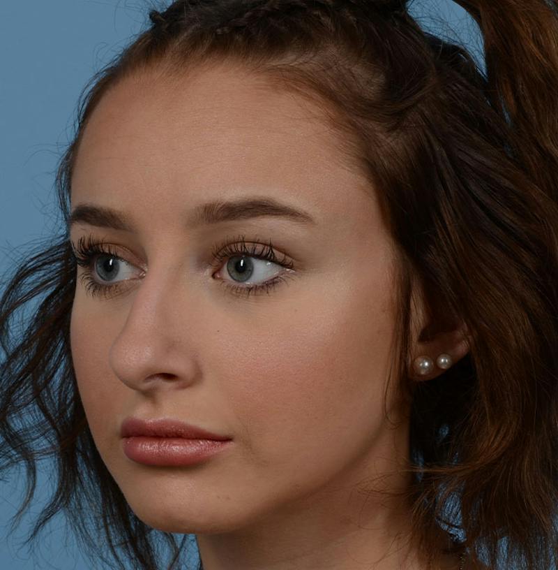 Rhinoplasty Before & After Gallery - Patient 170719 - Image 7
