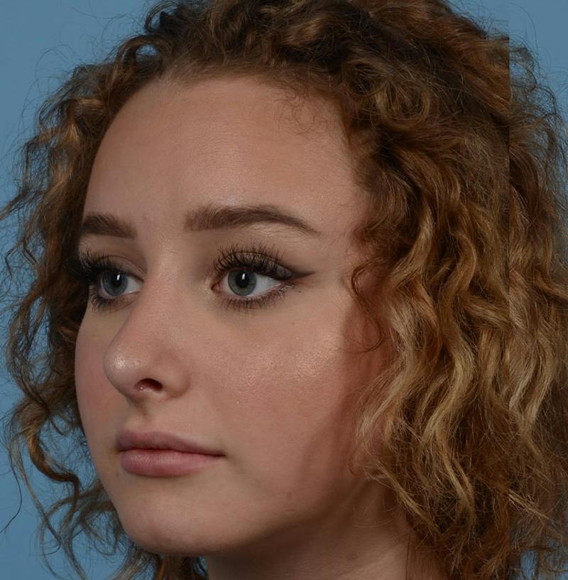 Rhinoplasty Before & After Gallery - Patient 170719 - Image 8