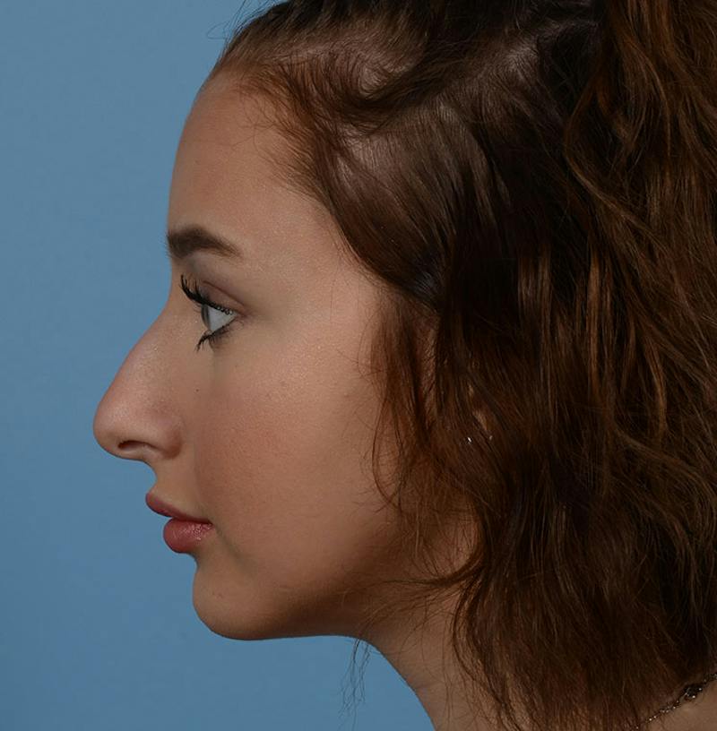 Rhinoplasty Before & After Gallery - Patient 170719 - Image 9