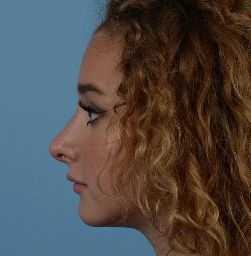 Rhinoplasty Before & After Gallery - Patient 170719 - Image 10