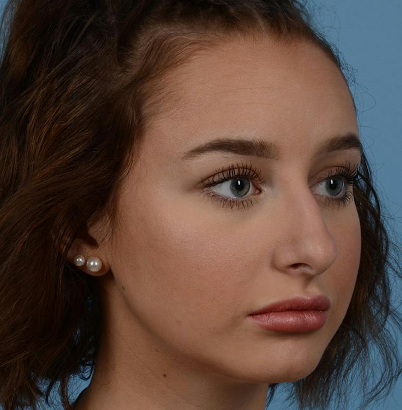 Rhinoplasty Before & After Gallery - Patient 170719 - Image 11