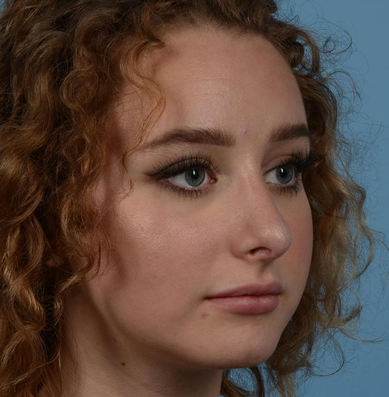 Rhinoplasty Before & After Gallery - Patient 170719 - Image 12