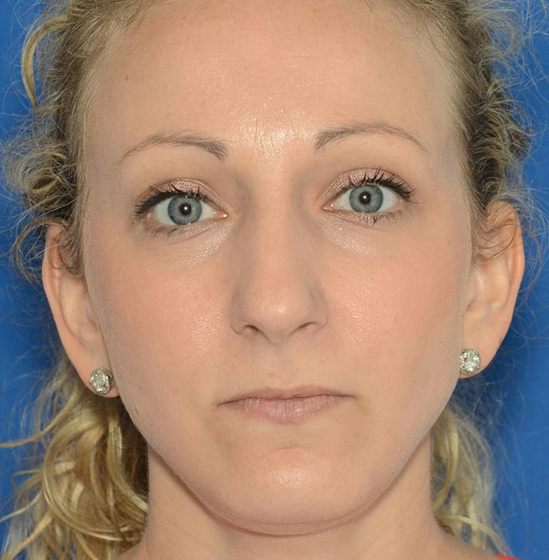 Rhinoplasty Before & After Gallery - Patient 115931 - Image 1