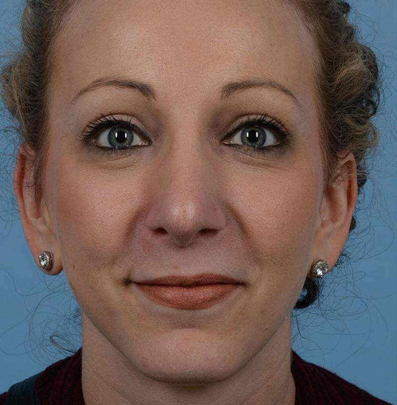 Rhinoplasty Before & After Gallery - Patient 115931 - Image 2