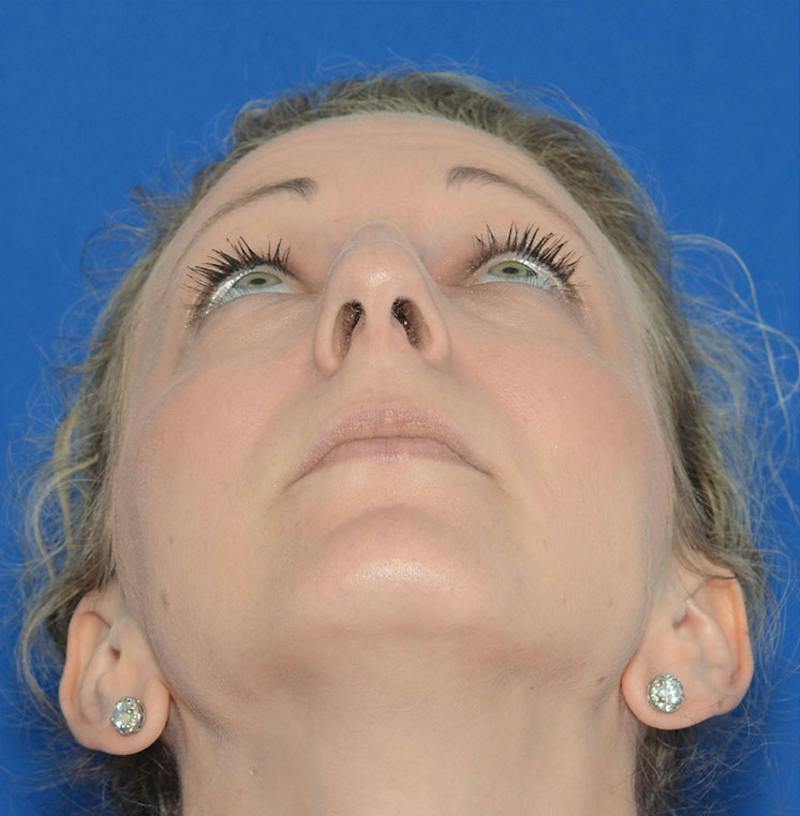 Rhinoplasty Before & After Gallery - Patient 115931 - Image 3