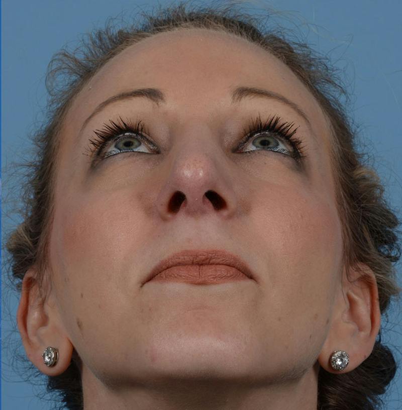 Rhinoplasty Before & After Gallery - Patient 115931 - Image 4